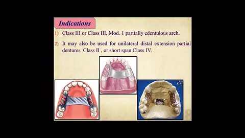 Prosthodontics L8 part2 (Maxillary Major Connectors)