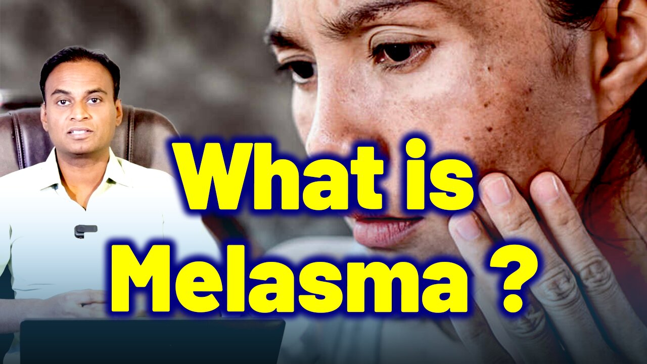 What Is Melasma ? | Dr. Bharadwaz | Homeopathy, Medicine & Surgery | Melasma Treatment & Cure