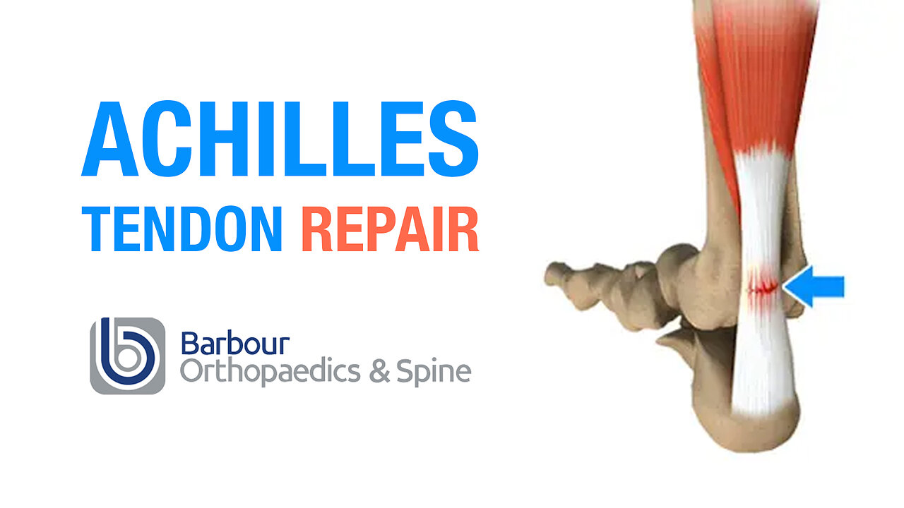 ACHILLES TENDON
