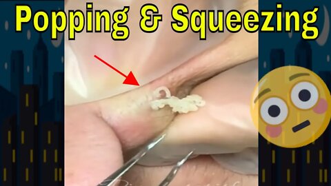 Popping & Squeezing Those Blackheads 😋🪱 #blackheadremoval #blackhead #blackheads #squeezing