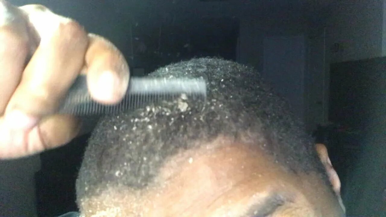 Big Dandruff Scratching Asmr