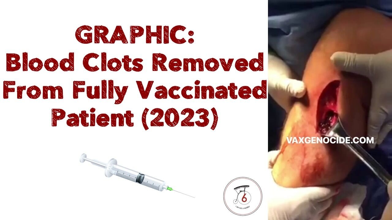 ⚠️ GRAPHIC: Blood Clots Removed From Fully Vaccinated Patient