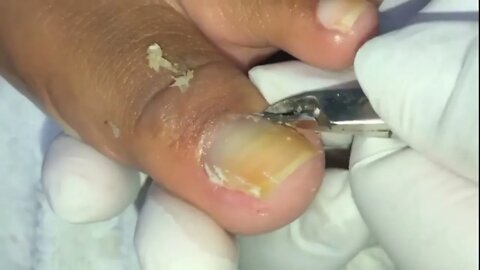 Oddly Satisfying Toenail Ingrown Removal. (Extremely Painful!!!)