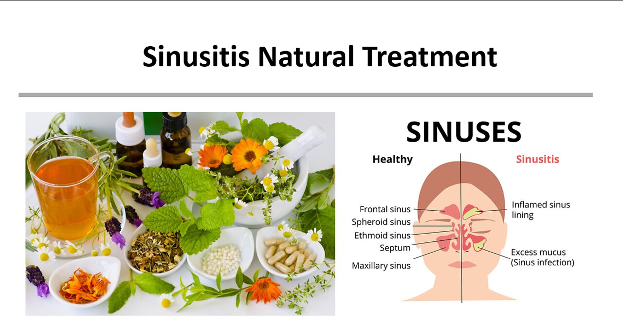 Sinusitis Natural Treatment Natural Treatment