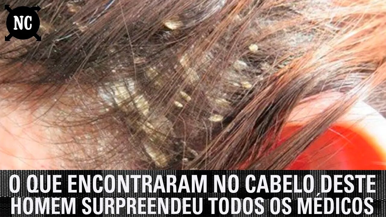 O que encontraram no cabelo deste homem surpreendeu todos os médicos