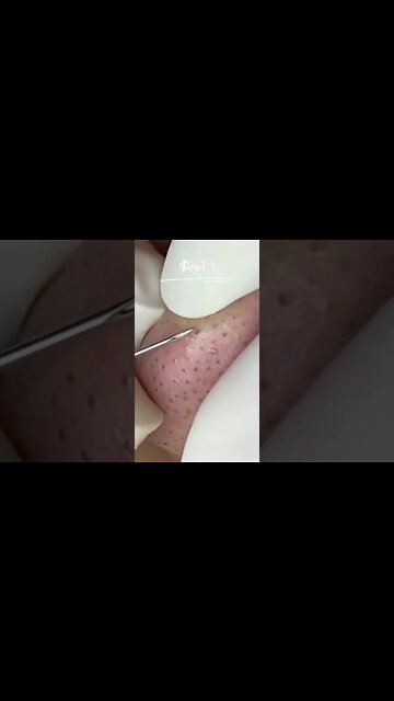 Disgusting BlackHeads Removal Nose