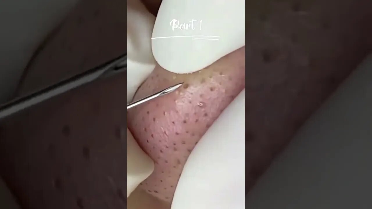 Disgusting BlackHeads Removal Nose