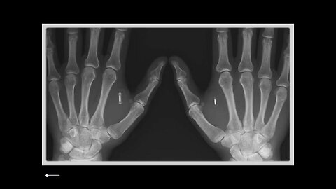 Greg Reese: Banking Insider Warns CBDCs Will Be Implanted Chips! [19.07.2023]