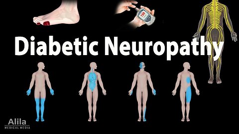 Diabetic Neuropathy, Animation