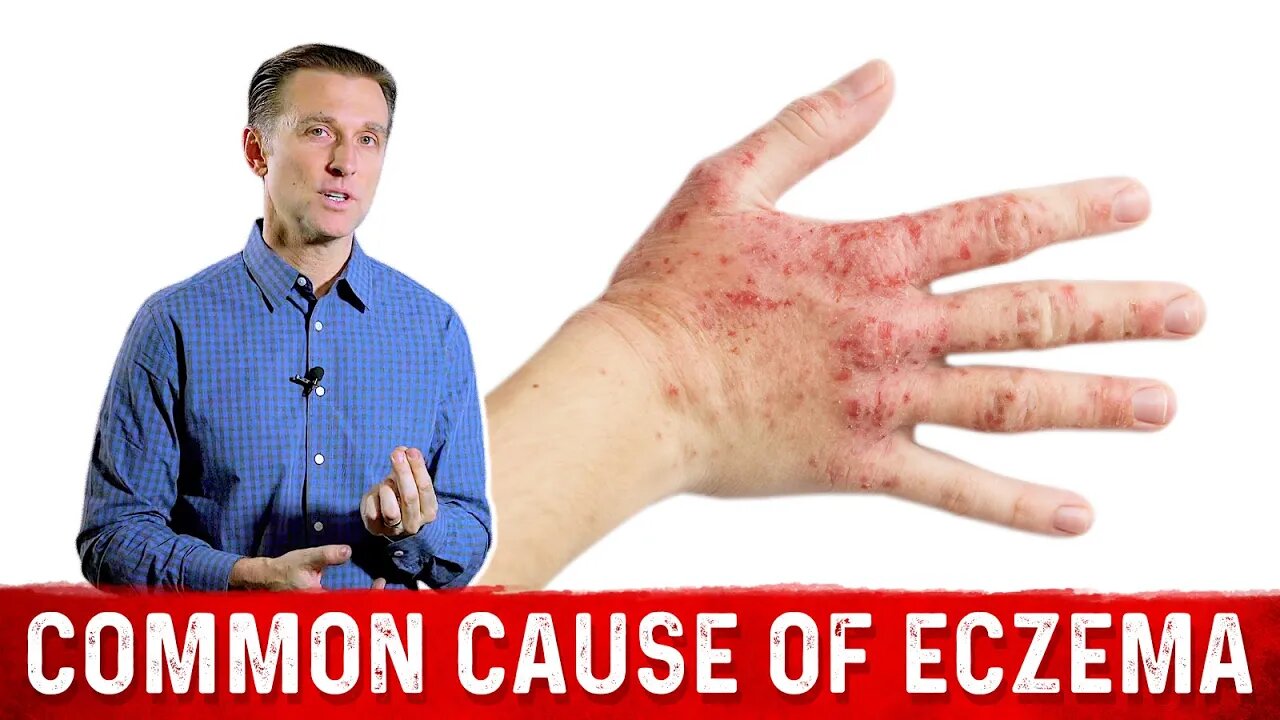 Is Your Eczema Coming from a Salicylate Sensitivity? – Dr. Berg On Atopic Dermatitis