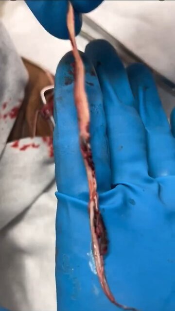 Richard Hirschman, Funeral Director And Embalmer Removing Clot From Jugular Vein