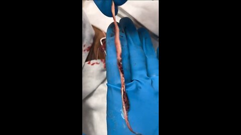 Richard Hirschman, Funeral Director And Embalmer Removing Clot From Jugular Vein