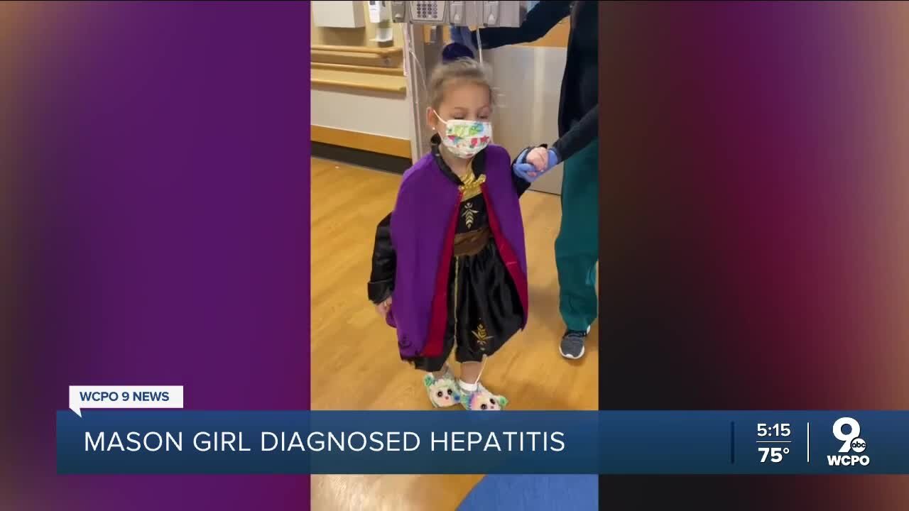 As cases rise nationwide, Mason girl diagnosed with hepatitis