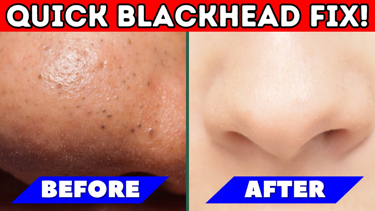 How To Get Rid Of Blackheads On Nose With Toothpaste