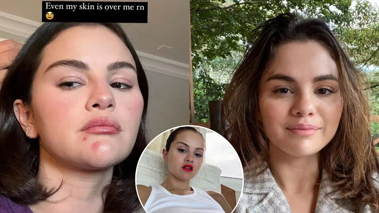 Selena Gomez Gets Real: Candid Photo of Her Skin Struggles!