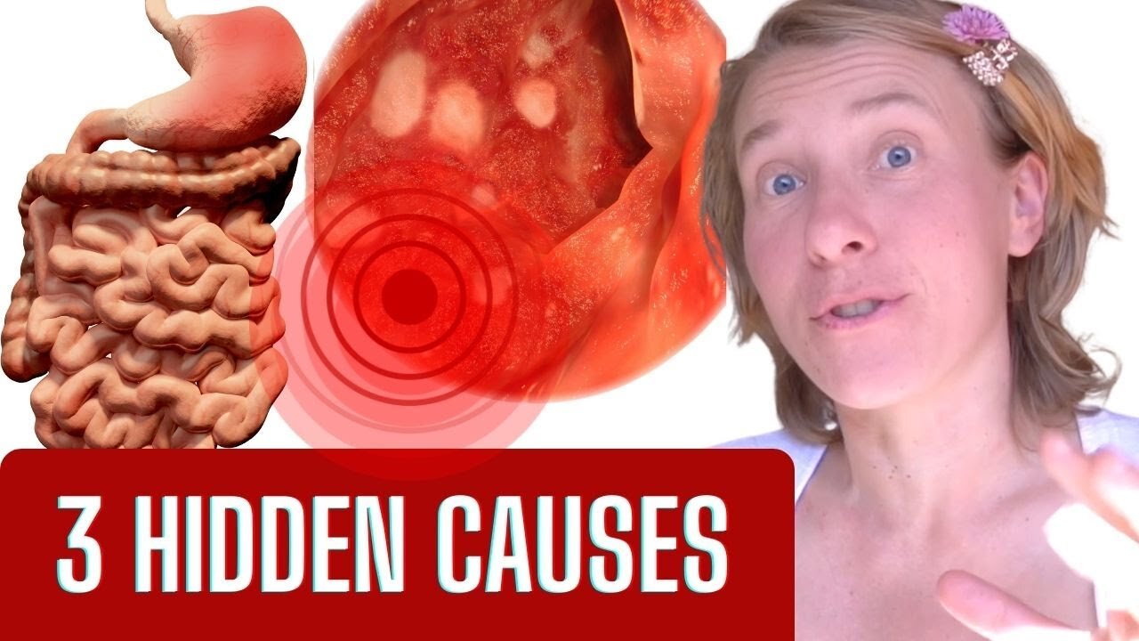 The Hidden Truth: What REALLY Causes Gastritis (SURPRISE!)