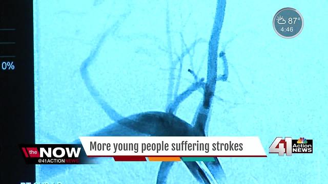 Strokes in younger adults are increasing