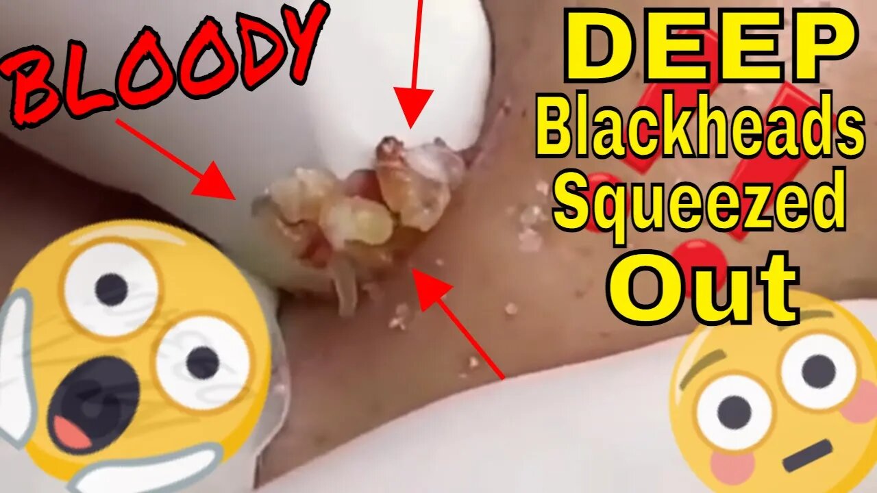 Bloody DEEP blackheads getting squeezed out of nose 😬👃 #blackheadremoval #blackhead #blackheads