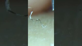 Longest Ingrown Hair Removal