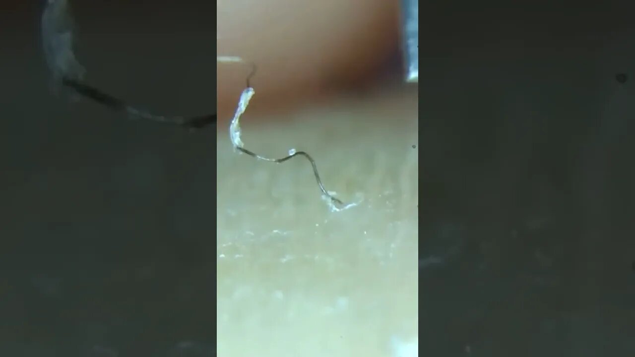 Longest Ingrown Hair Removal