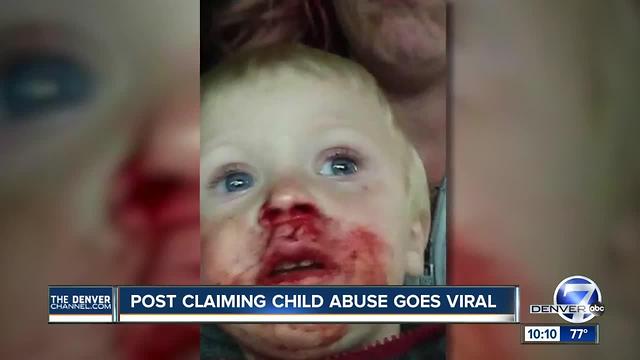 Mother shares her side of story after photo of bloody son goes viral