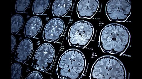 Shrinking Brain Syndrome & Lack of Sleep, Bob Gilpatrick