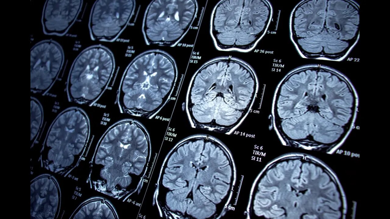Shrinking Brain Syndrome & Lack of Sleep, Bob Gilpatrick
