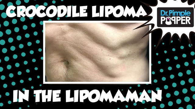 A crocodile Lipoma in LipomaMan!!