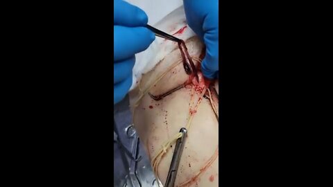 Unbelievable blood clots video from embalmer Richard Hirschman - Viewer Discretion Advised