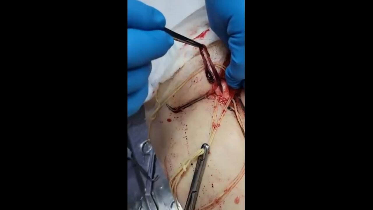 Unbelievable blood clots video from embalmer Richard Hirschman - Viewer Discretion Advised