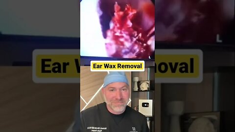 Most Satisfying Ear Wax Removal 😍 #shorts
