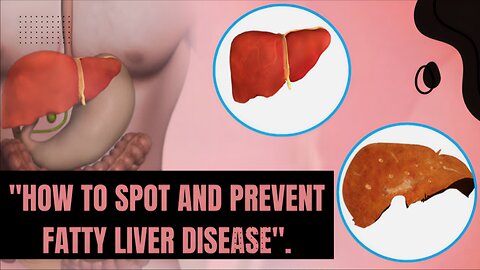 What is Fatty Liver? Causes, Symptoms, and Treatments