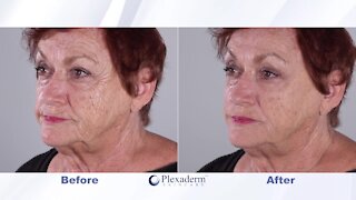 Don't look your age! Take the Plexaderm 10-minute challenge