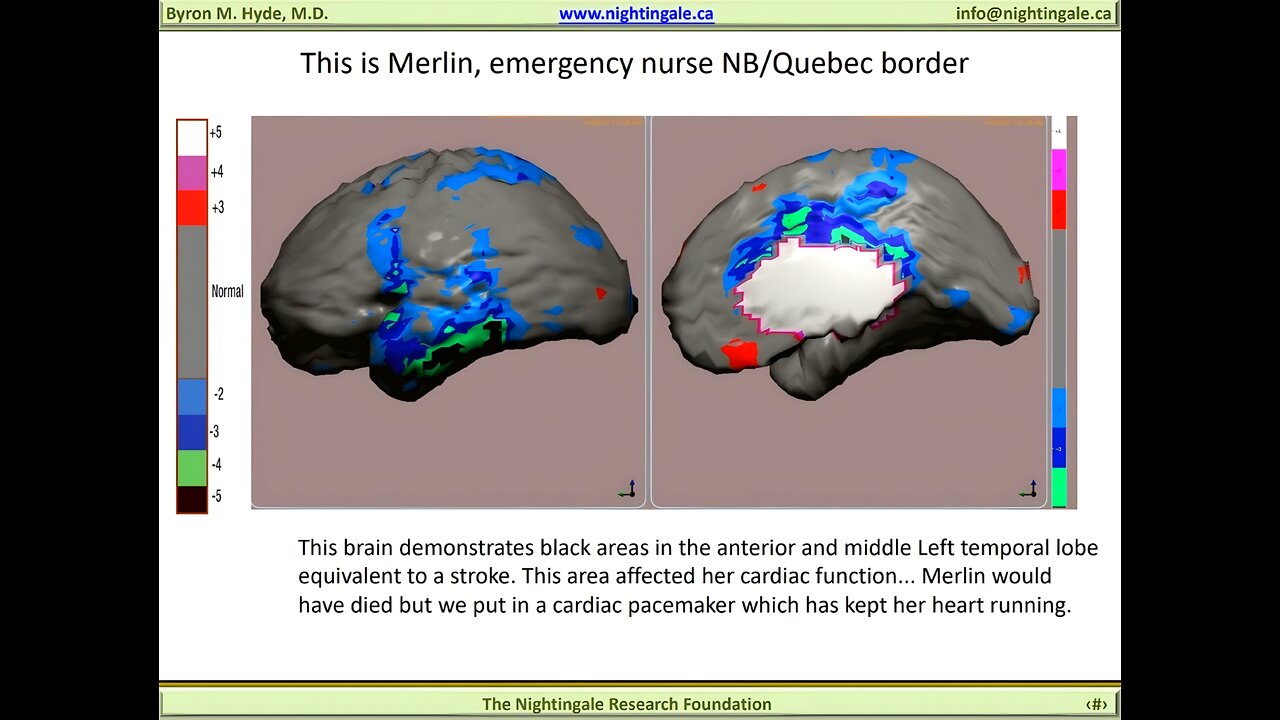 Emergency Room (E.R.) Nurse M.E. Brain SPECT Scan case - Byron Hyde, MD