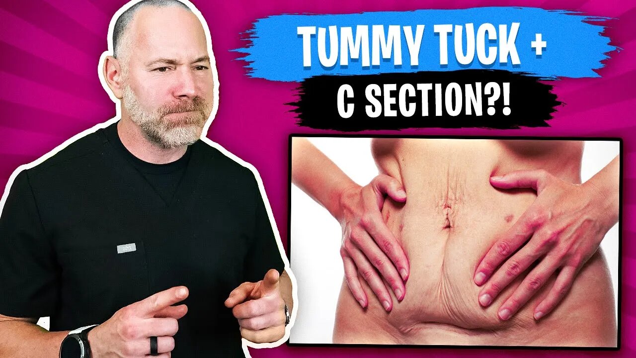 Watch This Before a Tummy Tuck!