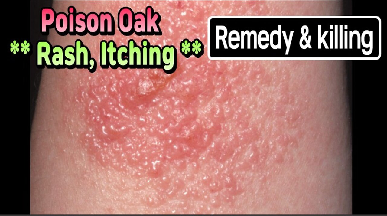 Poison Oak rash, itching, remedy and killing.