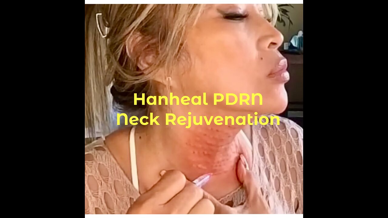 Neck Rejuvenation with Hanheal Facial Rejuvenation | marieliza10 discount code