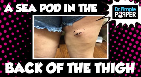 A Sea Pod in the back of the Thigh