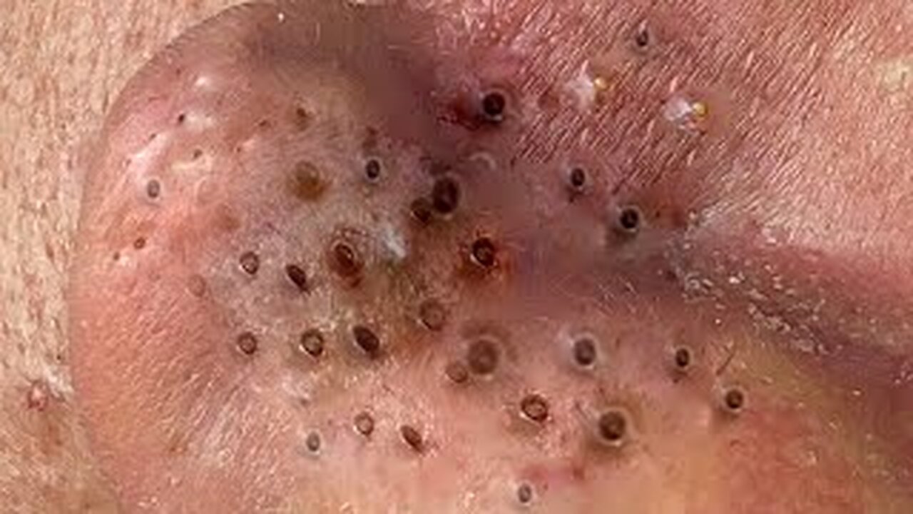 Blackheads Whiteheads Removal Dr Pimple Popper Cystic Acne Extractio 344