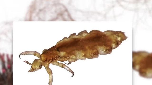 School asking for help to prevent lice outbreak