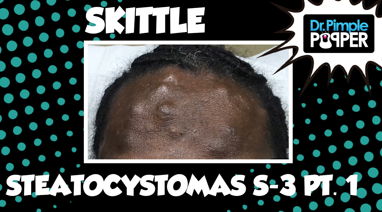 Skittle Steatocystoma Session Three, Part One