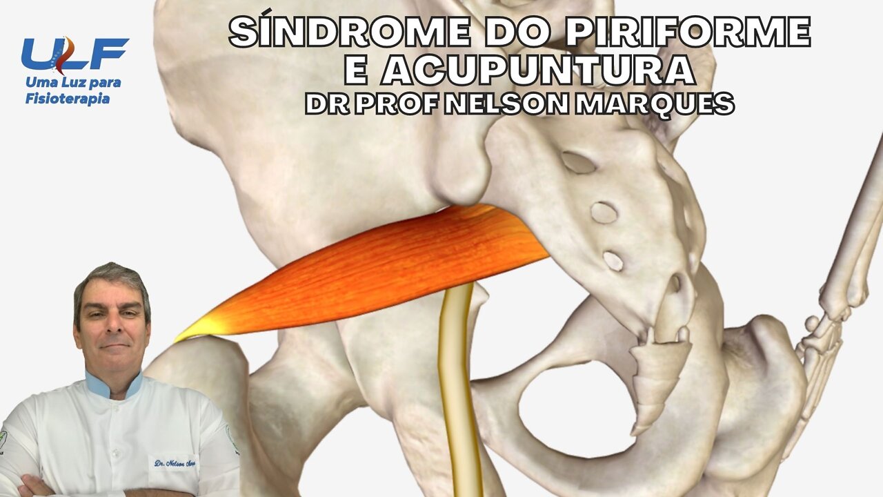 SÍNDROME DO PIRIFORME E ACUPUNTURA - Dr. Prof. Nelson Marques