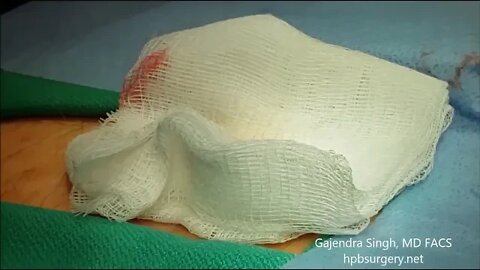 የደረት ቀዶ ጥገና - chest surgery