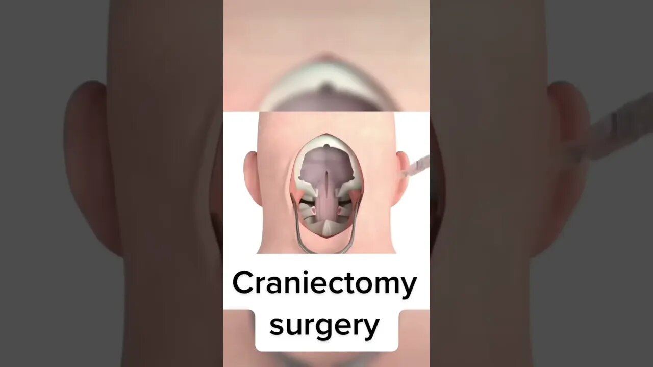 Craniectomy surgery #shorts #surgery #information