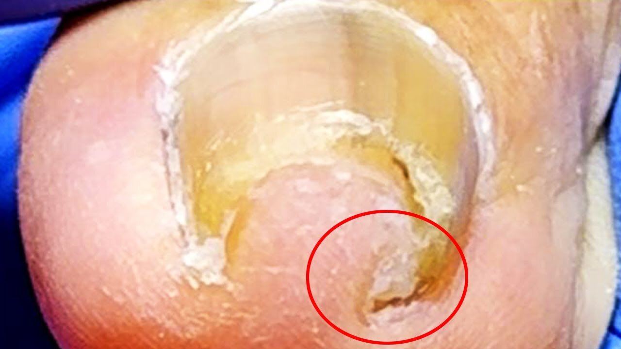 Extremely curled toenails, deeply ingrown nail beds