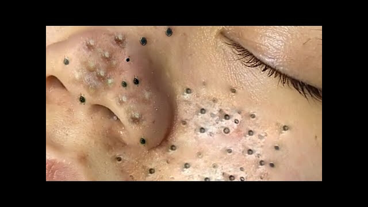 deep blackhead removal from cheeks blackhead extraction spa