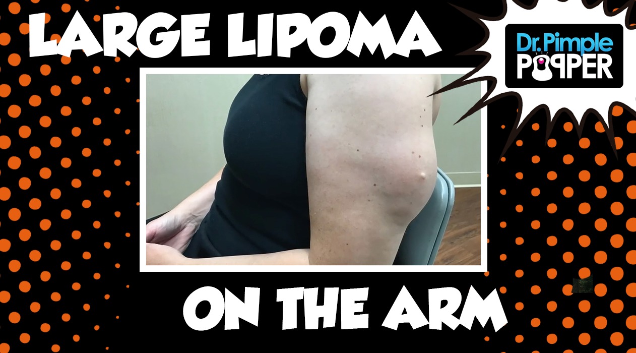 Your Lipoma Squish is On My List