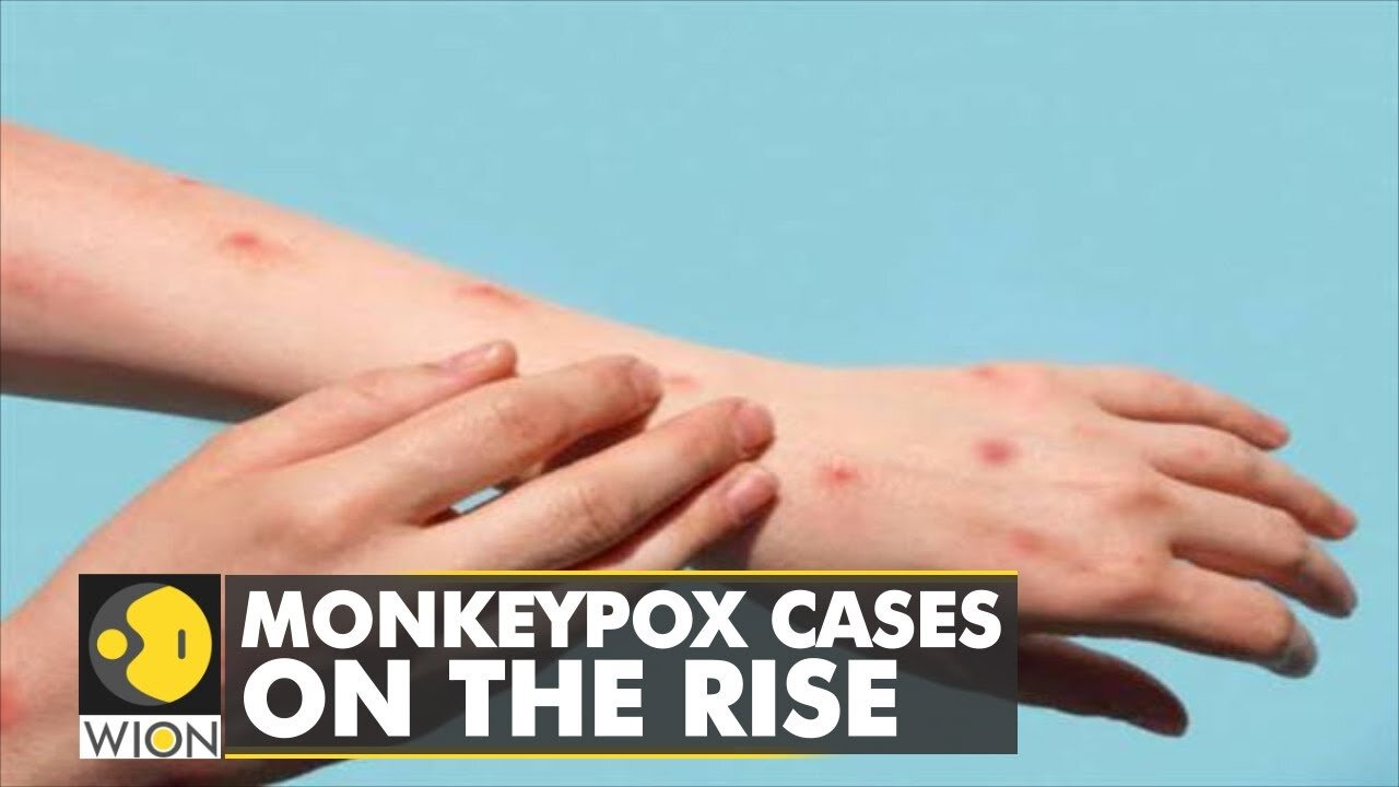 Monkeypox cases on the rise: What are the key symptoms of infection? | World News | WION