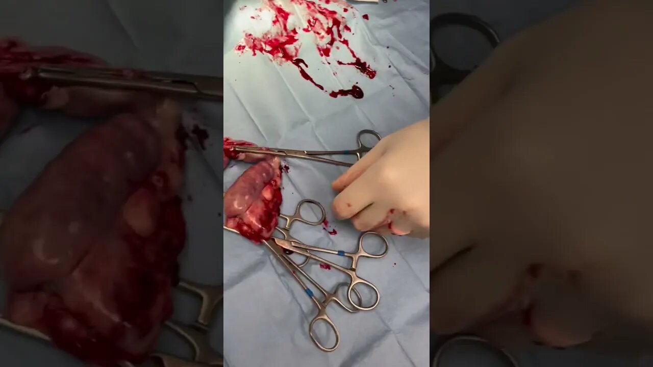Pyometra surgery in a dog. #veterinary #surgery #pyometra #spay_and_neuter #abscess #infection