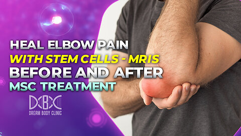 Heal Elbow Pain with Stem Cells - MRIs Before and After MSC Treatment at Dream Body Clinic